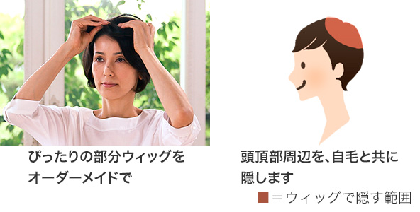 ぴったりの部分ウィッグをオーダーメイドで 頭頂部周辺を、自毛と共に隠します ■=ウィッグで隠す範囲