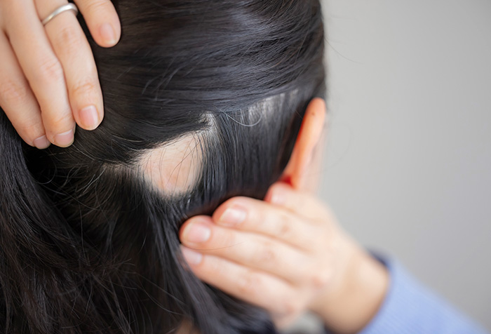 円形脱毛症の症状