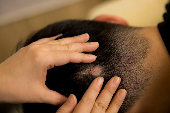 円形脱毛症の症状